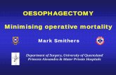OESOPHAGECTOMY Minimising operative mortality smithers 9.30 tues.pdf · OESOPHAGECTOMY; Minimising operative mortality. Mortality and Time: Decade patients % op mortality. 1960 -1979