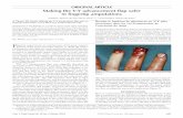 original article Making the V-Y advancement flap safer in ... · Making the V-Y advancement flap safer in fingertip amputations ... sutured to the nail bed, ... V-Y advancement flap
