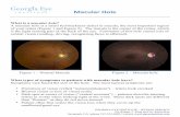 Macular!Hole! - Georgia Eye Institute · A macular hole is a small full-thickness defect in macula, the most important region of your retina (Figure 1 and Figure 2). The macula is
