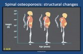 Spinal osteoporosis: structural changes (diagram)legeforeningen.no/PageFiles/245555/OSTEOPOROSE for... · Arth Rheum 2003; 48: 3224-9 GC users n=56 Nonusers n=1,899 Femoral neck BMD