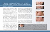 Novel Surgical Tool Achieves Efficacious Acne Scar …gatewaylasercenter.com/assets/TaylorLiberatorInformation.pdf · Before After The best instrument for performing acne scar subcision!