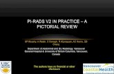 PI-RADS V2 IN PRACTICE – A PICTORIAL REVIEW · • PI-RADS v2 attempts to standardize prostate MRI reporting plus simplify ... • dynamic contrast enhancement is no longer a key