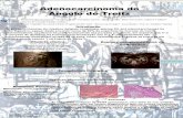 Adobe Photoshop Album Starter Edition 3repositorio.chlc.min-saude.pt/bitstream/10400.17/445/1/Poster... · Macroscopia - tumor com 10x4X3 cm, capsulado Microscopia- Adenocarcinoma