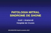 PATOLOGIA MITRAL SINDROME DE SHONE - … PATOLOGIA MITRAL SINDROME DE SHONE José I. Aramendi Hospital de Cruces SECARDIOPED Madrid noviembre 2015. ... • Congestive heart failure