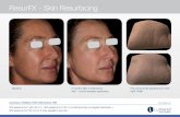 TM ResurFX - Skin Resurfacing · PB-1005298 Rev C Baseline After 5 treatments IPL with OPT + Multi-Spot Nd:YAG - PWS Courtesy of Dr. Matteo Tretti Clementoni, MD Nd:YAG 100 J/cm2,