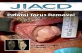 Palatal Torus Removal - jiacd.com · Palatal Torus Removal Stereolithographic Modeling. The Best Things in Life Are FREE! Subscribe now to enjoy articles free of charge that will