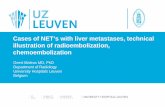 Cases of NET’s with liver metastases, technical ... · Cases of NET’s with liver metastases, technical illustration of radioembolization, chemoembolization . Geert Maleux MD,