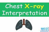 Normal Chest X-ray - medfreecon.files.wordpress.com · Hydropneumothorax •Air in pleural ...