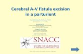 Cerebral A-V fistula excision in a parturient - snacc.org · craniotomy and resection of dural AV fistula with intra- operative angiogram. ... • Discharged home on 3rd post-op day