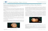 Otolaryngology: Open Access fileosteosarcoma are pain, swelling over bone and adjacent soft tissues, bulging and dislocation of tooth, lack of healing and swelling at the site of tooth