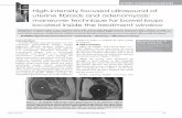 High-intensity focused ultrasound of · Imaging Med.I 111 (2018) 10(2) 29 High-intensity focused ultrasound of uterine fibroids and adenomyosis: maneuver technique for bowel loops