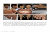 Nature Genetics: doi:10.1038/ng filepubertas praecox vera, (j) Brachytelephalangy, longitudinal ridges on finger nails, and keratosis pilaris on forearm. (k) Bulging of right humerus