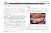 Facial Hair Restoration: Effective Techniques for Beard ... · facial hair restoration are for poorly thought out prior laser hair removal, scarring, burn, or cleft lip repair (Figure