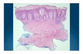 Lichen Amyloidosis-2 - DermpathMD.comdermpathmd.com/cases/slide atlas/Lichen Amyloidosis-2.pptx.pdfPearls% Irregular)epidermal) hyperplasia)withhyperC) and)parakeratotic)scale) Dermal)papillary)