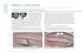 GLAUCOMA MIGS UPDATE - CRSToday · more information on this device, see Catch up With Glaucoma Today Journal Club.) Similarly, the Visco360 (Sight Sciences) involves 180º thread-ing