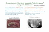 Osteonecrosis of the jaws associated with the use of ... · Osteonecrosis of the jaws associated with the use of yearly zoledronic acid HEAD & NECK,2011, DOI 10.1002/hed Era in terapia