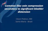 Common iliac vein compression secondary to significant ... · - Hemiparesis and neurogenic bladder - Duplex scan –No DVT but there was compression of the bilateral common iliac