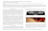 Dental Bur into the Maxillary Sinus: A Case Reportexodontia.info/files/OHDM_2017._Dental_Bur_into_the...Dental Bur into the Maxillary Sinus: A Case Report Kalyvas Demos, Kapsalas Andreas