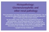 Histopathology: Glomerulonephritis and other renal pathology · Renal amyloidosis is a cause of nephrotic syndrome and chronic renal failure. Amyloid is a pathologic extracellular