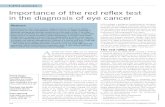 Importance of the red reflex test in the diagnosis of eye ...moscope or retinoscope through the pupil. The reflex observed is from a partial reflection of light from the highly vascularised