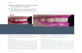 EN Bio-additive treatment in anterior teeth ES Tratamiento ... · resina fotocurable vittra aps in-office whitening gel (hydrogen peroxide) whiteness hp automixx adhesivo fotocurable