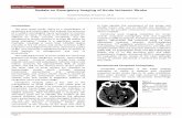 Update on Emergency Imaging of Acute Ischemic Stroke€¦ · suspected acute stroke due to its wide availability, short exam duration, and high presumed negative predictive value