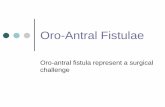 Oro-Antral Fistulaedoccdn.simplesite.com/d/a7/f2/282882356072084135... · Oro-Antral Fistulae Oro-antral fistula represent a surgical challenge. Etiology ... communication •Nose