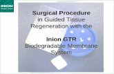 in Guided Tissue Regeneration with thecurasaninc.com/wp-content/uploads/2015/documents/... · Periodontal Defect Regeneration In a guided tissue regeneration procedure to treat periodontal