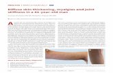 Diffuse skin thickening, myalgias and joint stiffness in a ... · PRACTICE E260 CMAJ | MARCH 5, 2018 | VOLUME 190 | ISSUE 9 Discussion Diffuse fasciitis with eosinophilia is an uncommon
