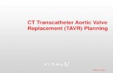 CT Transcatheter Aortic Valve Replacement (TAVR) PlanningTAVR-Measure/Modify Sinus of Valsalva Height Click on the Sinotubular Junction Size. This provides alignment for the Sinus