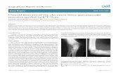 Osteoid osteoma of the olecranon fossa: percutaneous ... (1).pdf · immediate disappearance of the pain and a recovery of the elbow mobility. Histological examination confirmed the