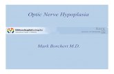 Optic Nerve Hypoplasia - NMSBVI Home · Optic Nerve Hypoplasia Prevalence 1970 30 cases 1980 1.8/100K 2/100K 1990 2000 6.3/100K 10.1/100K 7.2/100K 2010 Leading cause of pediatric