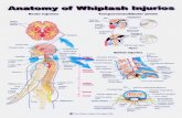 Anatomy of Whiplash Injuries - Mission Viejo Chiropractic › ... › 2011 › 08 › Whiplash-… · Prognosis Disc Normal spinal segment Disc Degenerated spinal segment Encroachment