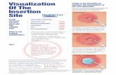 Visualization Of The EXIT SITE INFECTION? Insertion 2 ......“Tenderness, erythema, or site induration >2 cm from the catheter site along the subcutaneous tract of a tunneled (eg,