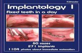 umbeat I1 v 20x26 - zahnarzt-zerbst.de · 12 lower jaw implants, 36 additional implant placement, bridge 8 x extraction, 15 lower jaw implants, 43 explantation 33-37/32-47 zirconium