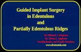 Guided Implant Surgery in Edentulous and Partially Edentulous · PDF file Guided Implant Surgery in Edentulous and Partially Edentulous Ridges Dr. Michael J. Maginnis Dr. Glenn E.