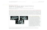 Imaging of Adult Atrial Septal Defects With CT Angiography · ATRIAL SEPTAL DEFECTS (ASD) ACCOUNT FOR 5% TO 10% OF ALL CASES OF CONGENITAL heart disease and as many as 30% of cases