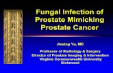 Fungal Infection of Prostate Mimicking Prostate Cancer · Teaching Points at Mp-MRI Ø Fungal infection of prostate may demonstrate a soft tissue mass with diffusion restriction in