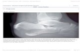 Calcaneus - Reduction & Fixation - ORIF - screw fixation - AO …bonefix.co.nz/portals/160/images/Avuslion calcaneal tuberosity fract… · Calcaneus - Extreme tongue-type (beak)