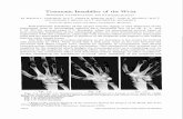Traumatic Instability of the Wrist · include all cases of carpal instability reviewed in the Hand Clinic of the Mayo Clinic over a tdo-year period. From this study a simple classification~of