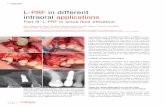 L-PRF in different intraoral applications€¦ · provides lateral access to the maxillary sinus with a minimally invasive osteotomy. An incision of relatively small dimensions is