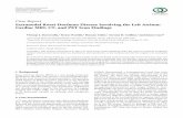 Case Report Extranodal Rosai-Dorfman Disease Involving the ...downloads.hindawi.com/journals/crira/2015/753160.pdf · venous drainage at this time. Mediastinal lymphadenopathy ...