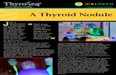 A Thyroid Nodule · with thyroid nodules. The clinical assessment by an Endocrine Oncologist was followed immediately by an ultrasound, which confirmed the nodule, classified as “intermediate-to-high-suspicion