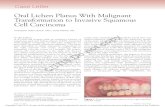 Oral Lichen Planus With Malignant Transformation to ......Oral lichen planus and malignant transformation: a longitudinal cohort study [published online ahead of print July 22, 2011].
