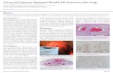 A Case of Cutaneous Metastatic Renal Cell Carcinoma to the ... · maintains similarities to the primary lesion, but the presence of lymphatic and vascular infiltration, anaplasia