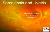 Sarcoidosis and Uveitis - KBB · Sarcoidosis a multisystem chronic inflammation causing multifocal non-caseating granulomas BUT – Diagnosis often made indirectly (without histology)