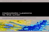 Metastatic Lesions to the Liverdownloads.hindawi.com/journals/specialissues/258563.pdffact that most metastatic liver tumors are supplied by the hepatic artery [6, 7], hepatic artery