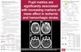Quantitative Pupillometry and Radiographic Midbrain ...€¦ · Variability of radiographic measurements was taken between two raters to evaluate measurement reliability of measurements.