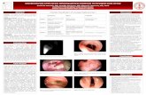 Abstract Chandler Classification of Laryngeal ... · Chandler Classification of Laryngeal Radionecrosis a A Adapted from Cukurova I, Cetinkaya EA. Radionecrosis of the larynx: Case