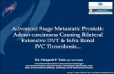 Advanced Stage Metastatic Prostatic Adeno-carcinoma ......Advanced Stage Metastatic Prostatic Adeno-carcinoma Causing Bilateral Extensive DVT & Infra Renal IVC Thrombosis... Dr. Mangesh